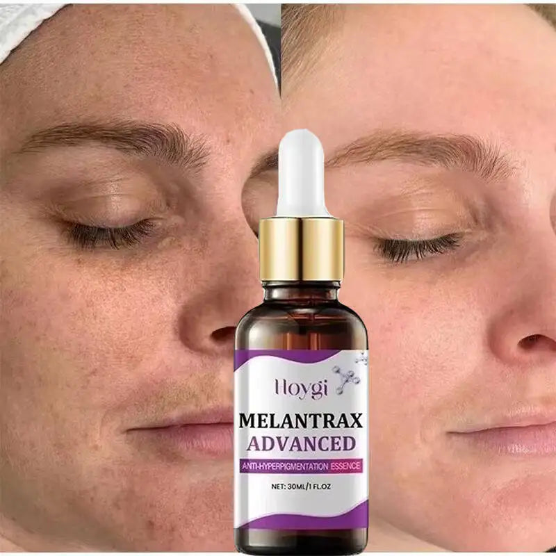 Hoygi – Melantrax Advanced | Essence Anti-Hyperpigmentation & Taches 30ml